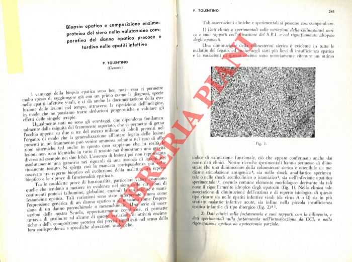Biopsia epatica e composizione enzimo-proteica del siero nella valutazione comparativa del danno epatico precoce e tardivo nelle epatiti infettive. - TOLENTINO P. -