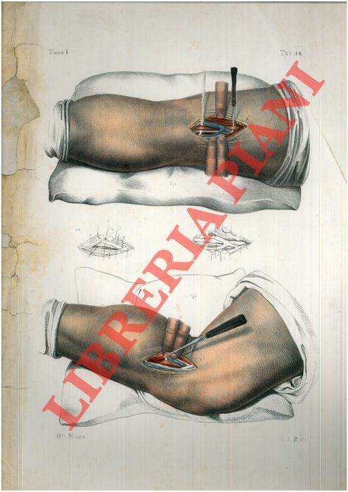(Bourgery) - - Allacciatura dell'arteria poplitea. Adulto, met del naturale.