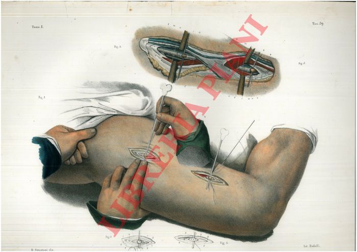 (Bourgery) - - legatura dell'arteria femorale. Adulto, met del naturale.