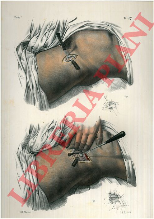 (Bourgery) - - Allacciatura dlle arterie femorale, ed iliaca esterna. Adulto, met del naturale.
