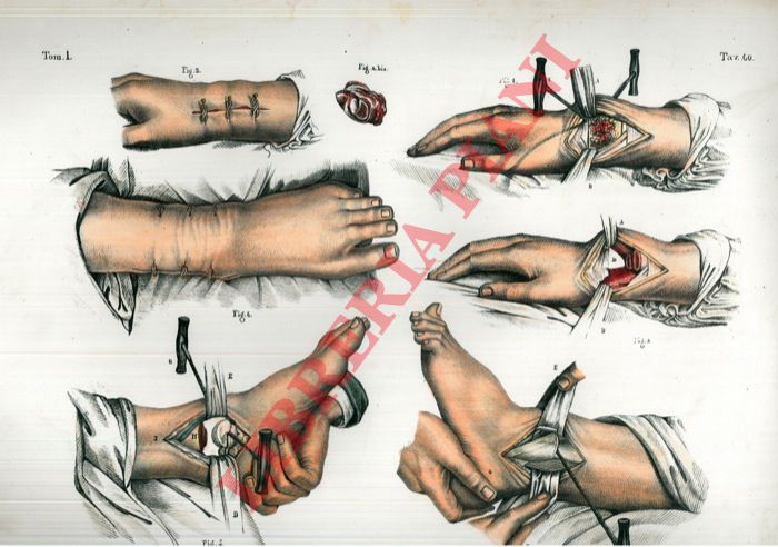 (Bourgery) - - Resezioni. (3).