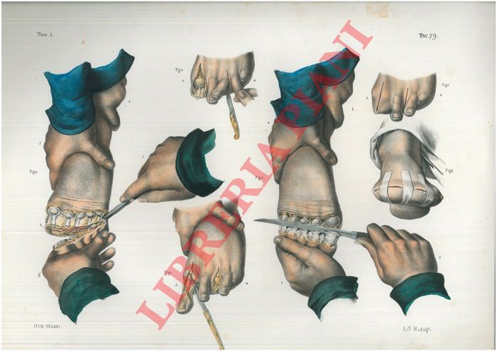 (Bourgery) - - Amputazioni delle dita del piede.
