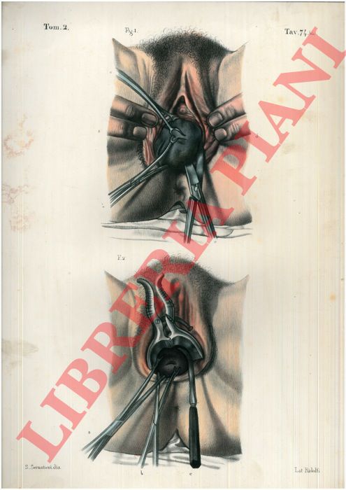 (Bourgery) - - Operazioni sopra l'utero canceroso.